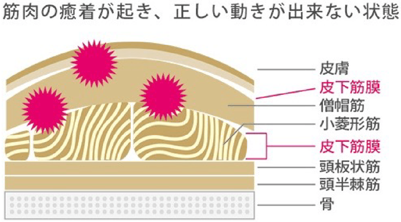 筋膜の癒着・ねじれが引き起こす症状